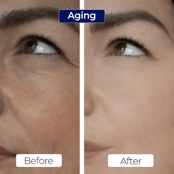 Acne Facewash Results